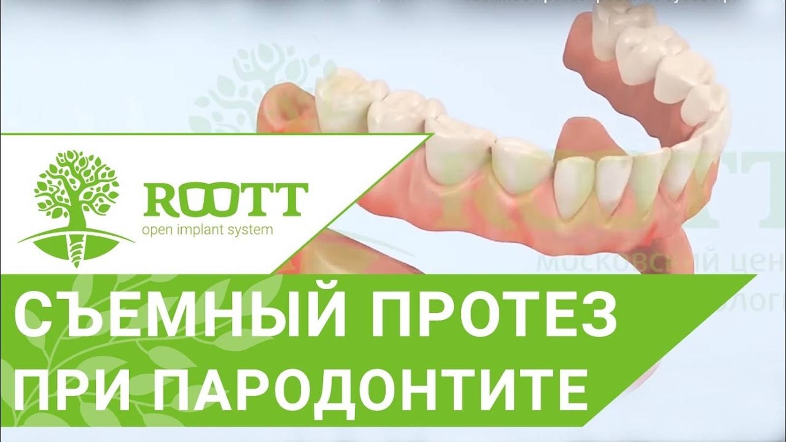 Съемное протезирование зубов при пародонтите смотреть онлайн
