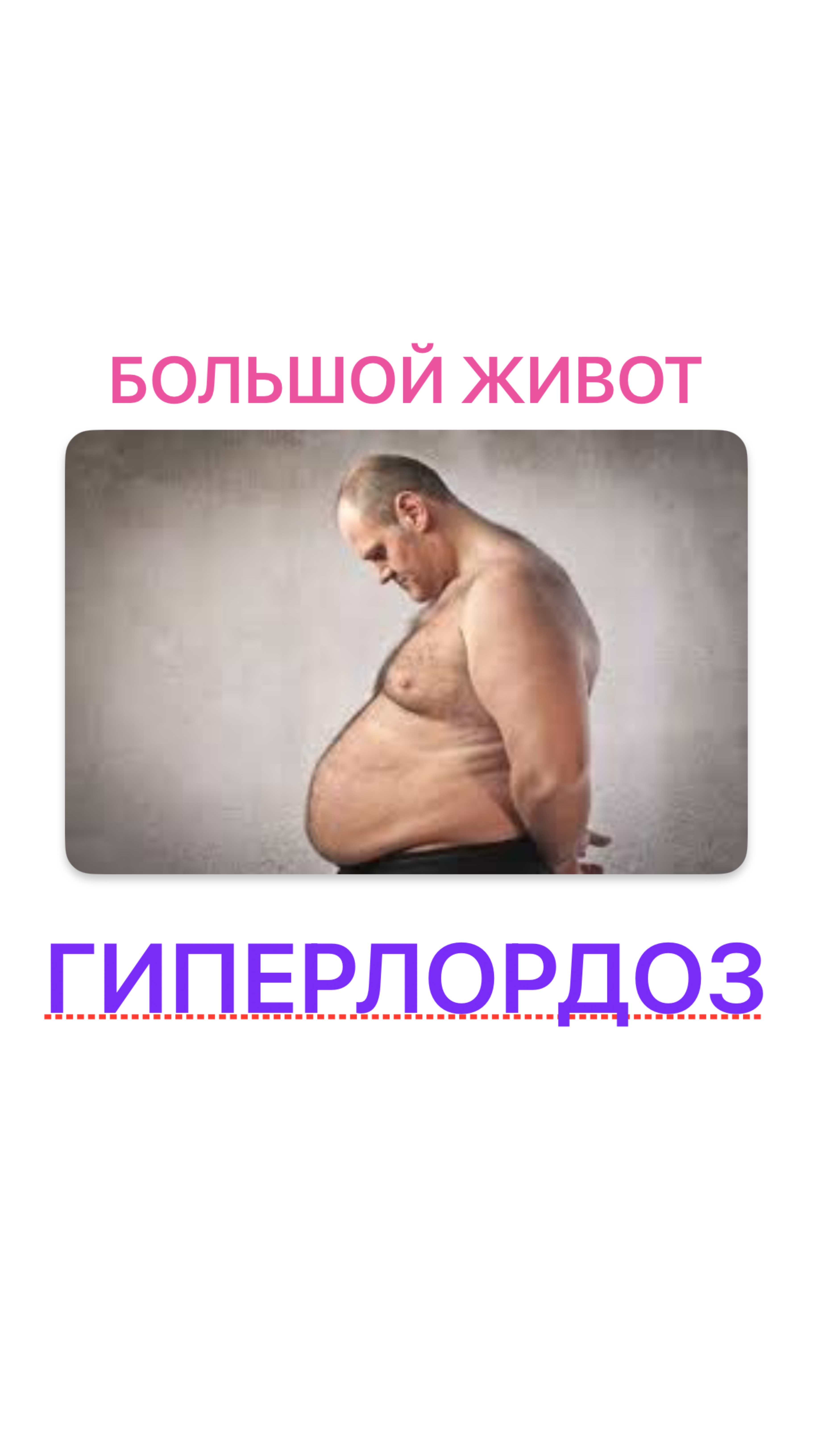 Разоблачаю миф про гиперлордоз. Настоящая причина большого живота