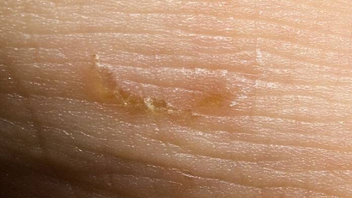 Чесотка_ заразна_ Чесоточный Клещ - Морфорлогия, Жизненный Цикл, Диагностика, Лечение, Профилактика смотреть онлайн