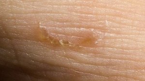 Чесотка_ заразна_ Чесоточный Клещ - Морфорлогия, Жизненный Цикл, Диагностика, Лечение, Профилактика