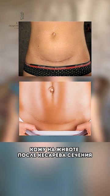 Плацента на рубце – почему это опасно? #естественныероды #позывродах #комфортвродах #поддержкаженщин смотреть онлайн