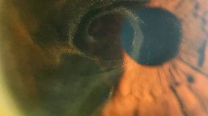 РОГОВИЦА _ Анатомия и функции роговицы _ из-за чего МУТНЕЕТ роговица?