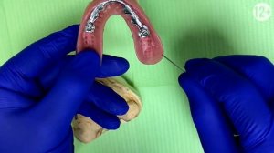 Протезирование Зубов при Полной Потере на 4 Имплантах