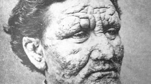 Лепра (Mycobacterium leprae) Морфология, Патогенез, Клиника, Лабораторная Диагностика и Профилактика