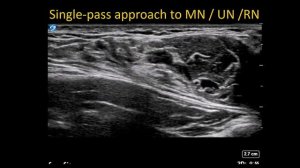 Блокада плечевого сплетения подмышечным доступом 2
