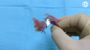 НЕВИДИМЫЙ Бюгельный Протез На Верхнюю Челюсть