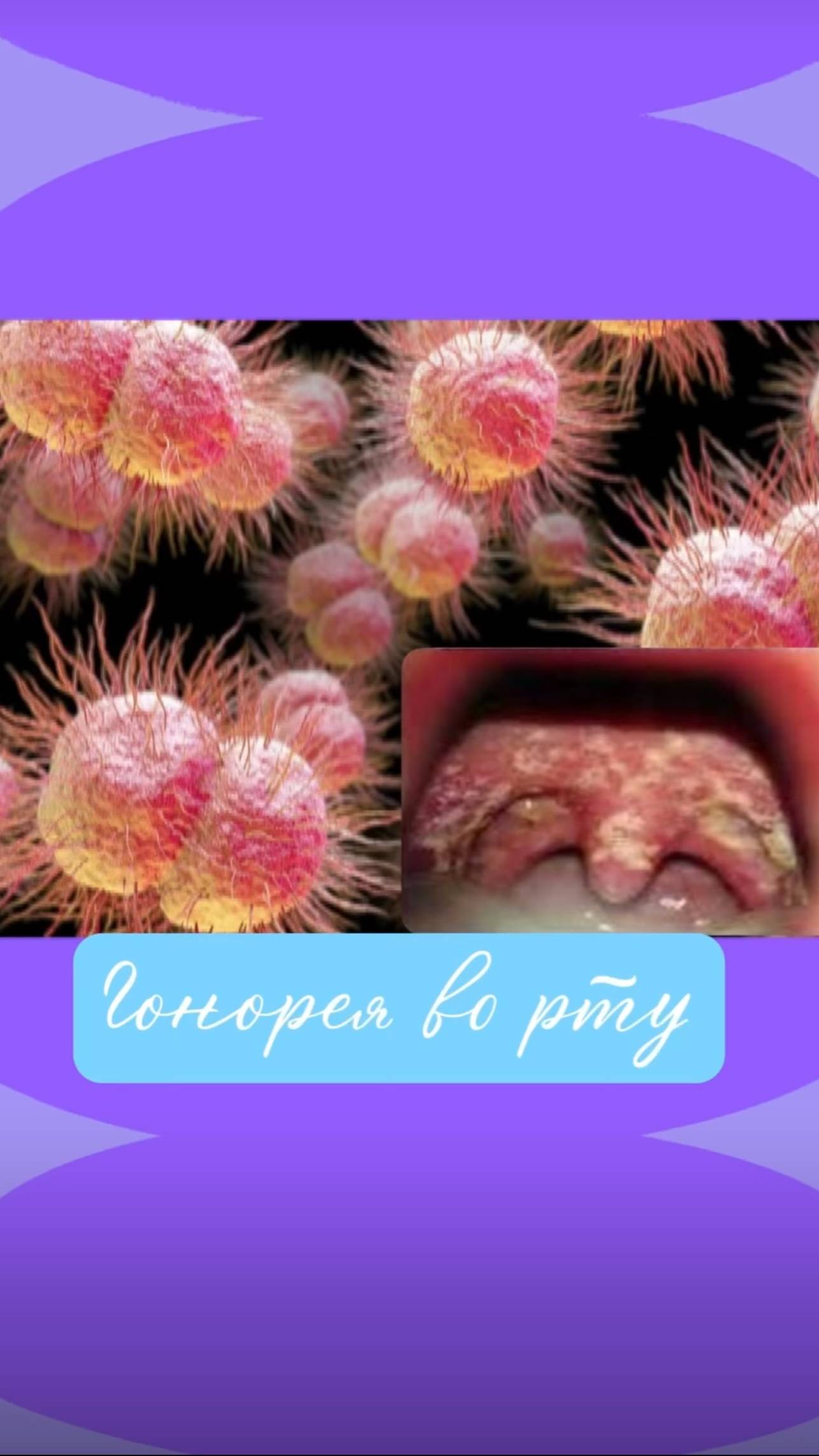 Гонорея во рту смотреть онлайн