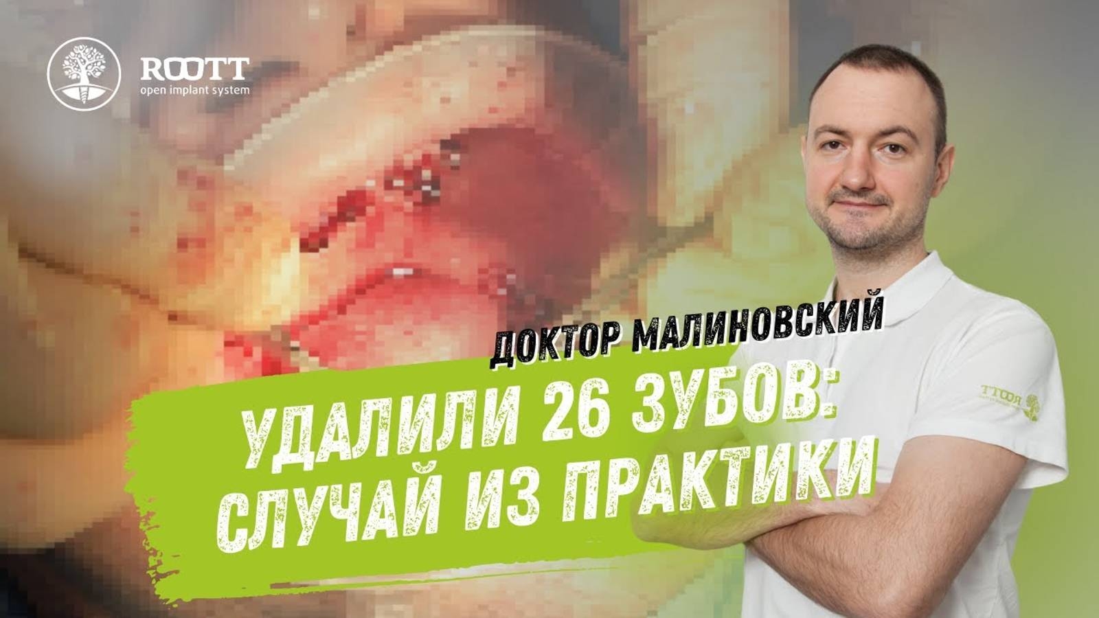 Имплантация зубов при пародонтите Диагностика, процесс операции, ИТОГИ смотреть онлайн