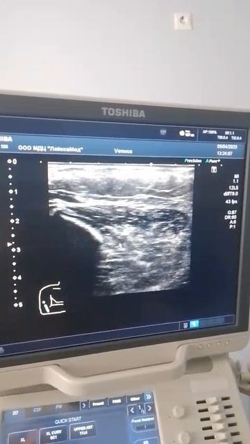 Состояние лучевого нерва после остеосинтеза правого плеча