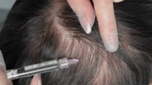 PLINEST fast Трихология