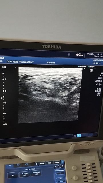 УЗИ паховой области. Грыжа.