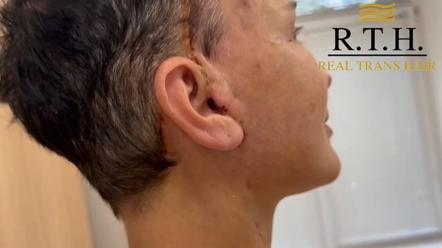 SMAS-подтяжка и нижняя блефаропластика. Результат через 2 недели. Хирург: Елена Чирикова. смотреть онлайн