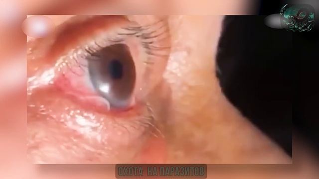Гигантский паразит под кожей! Срочное удаление!