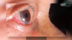 Гигантский паразит под кожей! Срочное удаление!