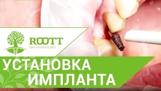 Процесс установки импланта ROOTT безоперационным методом смотреть онлайн