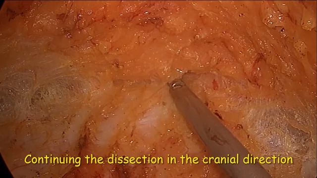 Эндоскопическая пластика диастаза прямых мыщц живота
