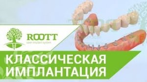 Классическая имплантация зубов на нижней челюсти. Имплантация зубов на нижней челюсти