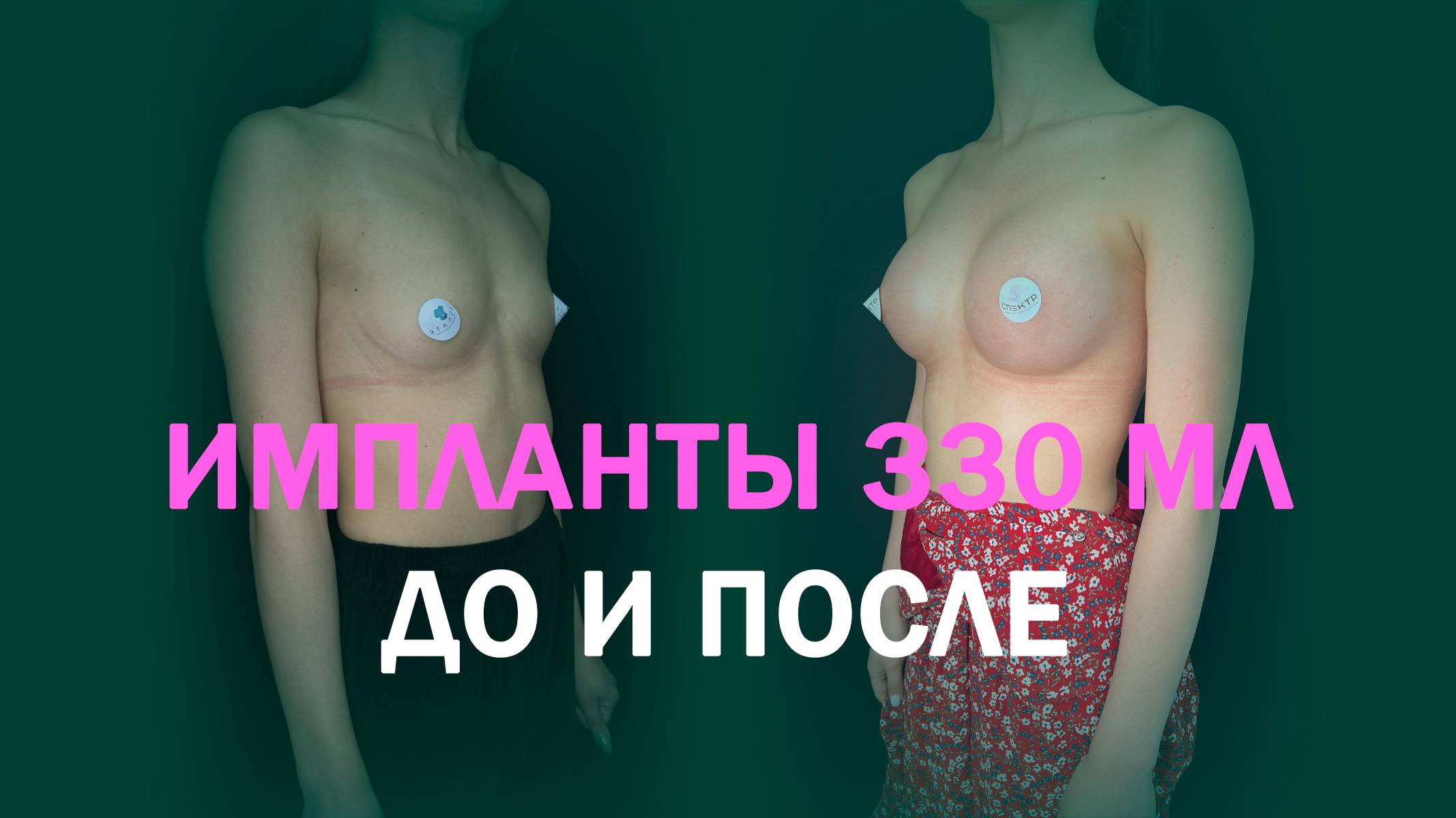 Увеличение груди анатомическими имплантами Mentor 330 мл