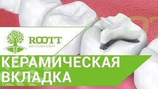 Как устанавливают керамические вкладки, их преимущества. Керамические вкладки установка. смотреть онлайн