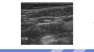 Лимфоузлы на шее, УЗИ лекция для врачей (сон)