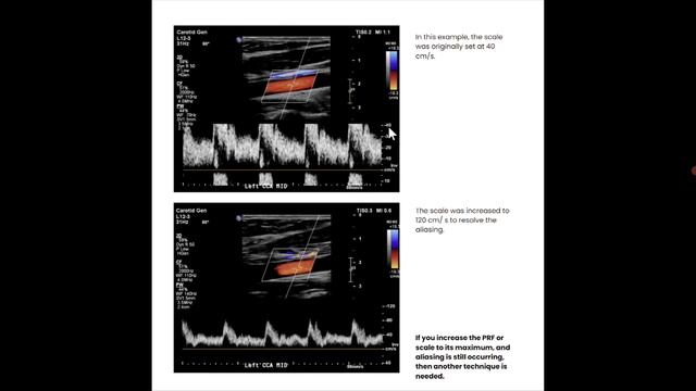 Основы УЗИ Применение допплера, лекция для врачей УЗИ смотреть онлайн