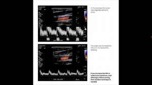 Основы УЗИ Применение допплера, лекция для врачей УЗИ