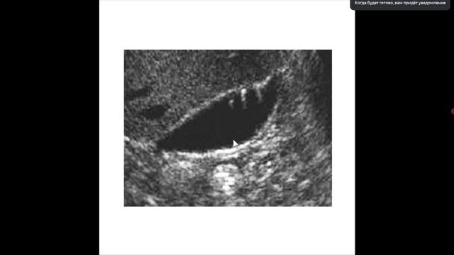 Основы УЗИ артефакты, лекция для врачей УЗИ (сон)