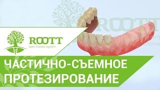Частично съемное протезирование после удаления зуба. Частично съемное протезирование. ROOTT смотреть онлайн