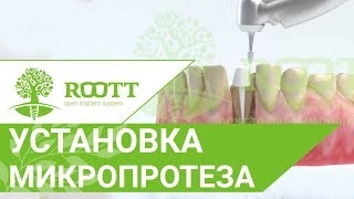 Как проходит микропротезирование зубов. Микропротезирование зубов. ROOTT смотреть онлайн