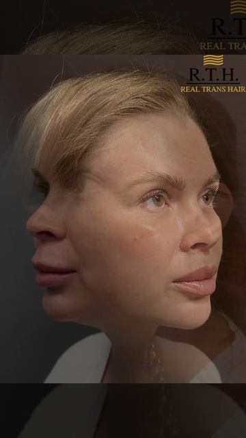 Результат: булхорн и липосакции подбородка спустя 3 месяца! смотреть онлайн