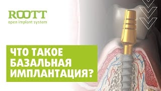 Базальная имплантация зубов. Использование метода базальной имплантации зубов в клинике ROOTT Москв смотреть онлайн