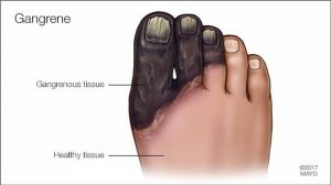 Порча на гниение ног. Мощная чистка, защита!