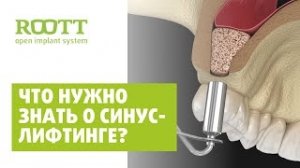 Синус лифтинг. Как делается? Операция синус лифтинга при имплантации зубов