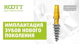 Как устанавливают компрессионные импланты зубов ROOTT (РУТ)? Этапы процесса имплантации зубов смотреть онлайн