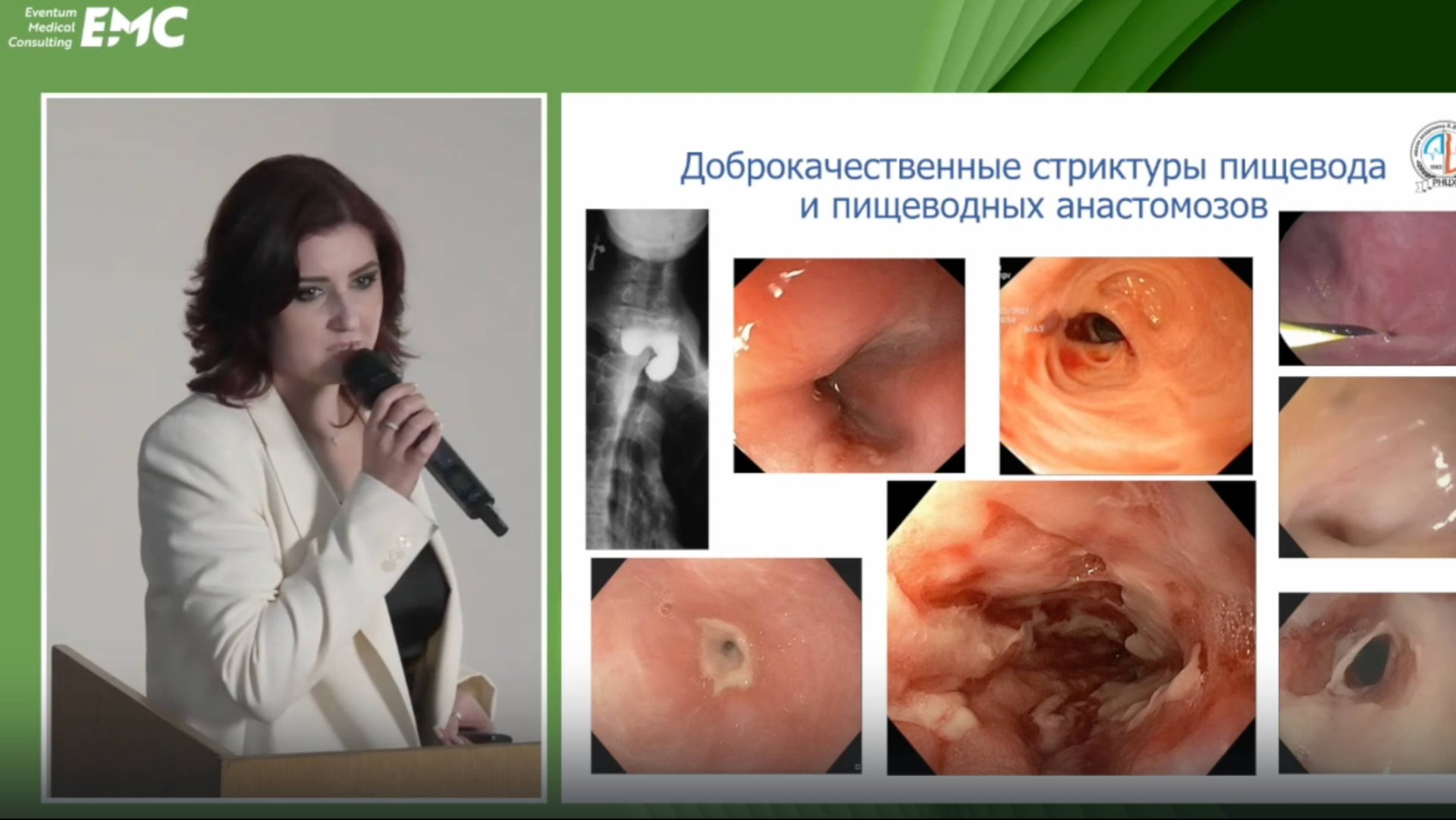 6. Белисова ТВ Рефрактерные рубцовые стриктуры пищевода и анастомозов. Результаты комбинир. лечения.