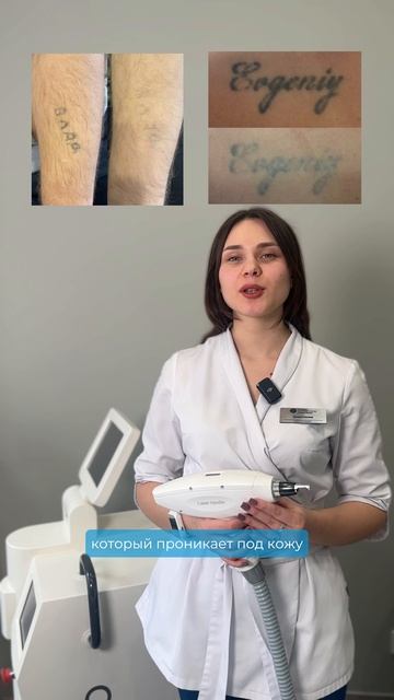 Удаление тату лазером Capello