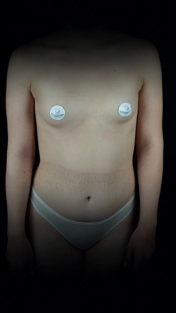 Небольшое увеличение для небольшой груди - естественный и гармоничный результат операции