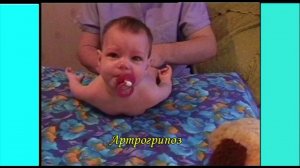 Артрогрипоз