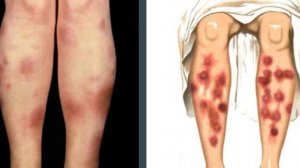 Узловатая Эритема - Этиология, Классификация, Клиническая картина, Диагностика. Лечение