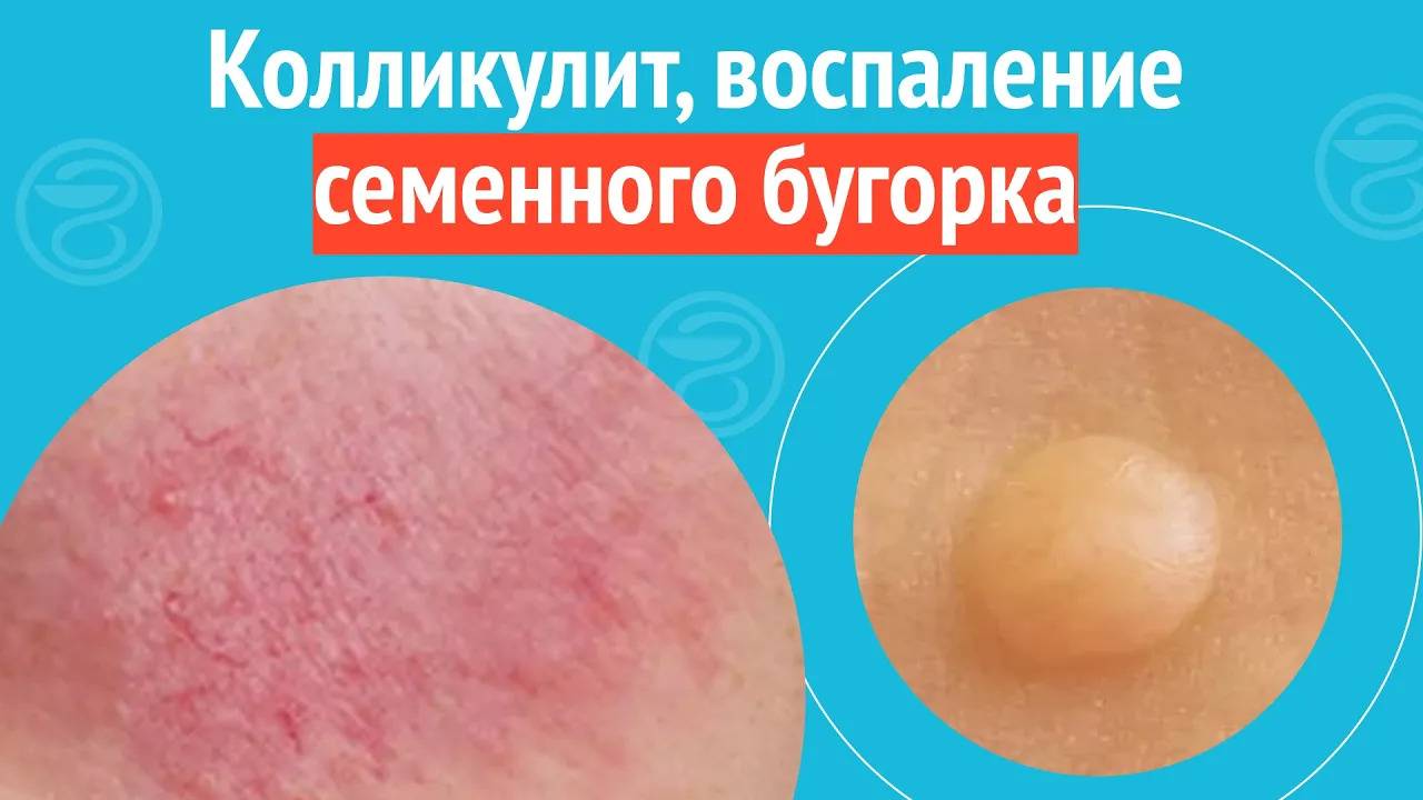 😨 Колликулит, воспаление семенного бугорка. Клинический случай №1666 смотреть онлайн