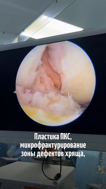 Коленный сустав, тяжелое разрушение