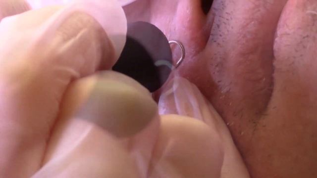 Удаление сосудов крыльев носа. ППИЭ смотреть онлайн