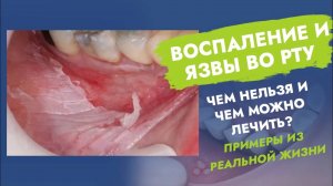 Во рту воспаление и язвы. Чем лечить, что категорически нельзя?