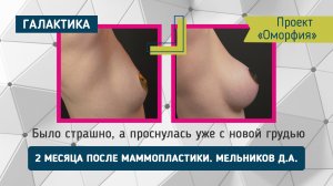 Оморфия "Новая грудь — новое Я!" | Маммопластика у Дмитрия Мельникова — результат через 2 месяца