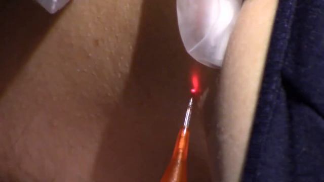 Кристалл. Удаление новообразований. ППИЭ смотреть онлайн