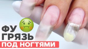 Грязь под ногтями после ОГОРОДА | Коррекция и поднятие клюющих ногтей