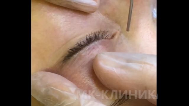 Лазерная блефаропластика смотреть онлайн