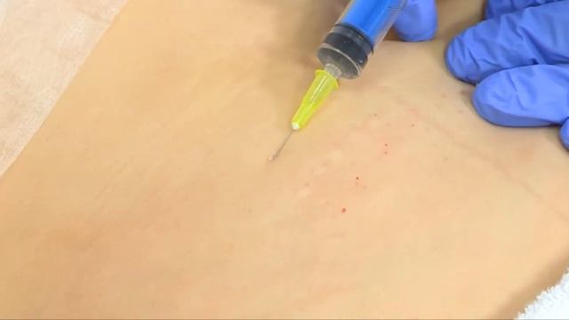 Техники мезотерапии с объяснением (Палатай М.А.) смотреть онлайн