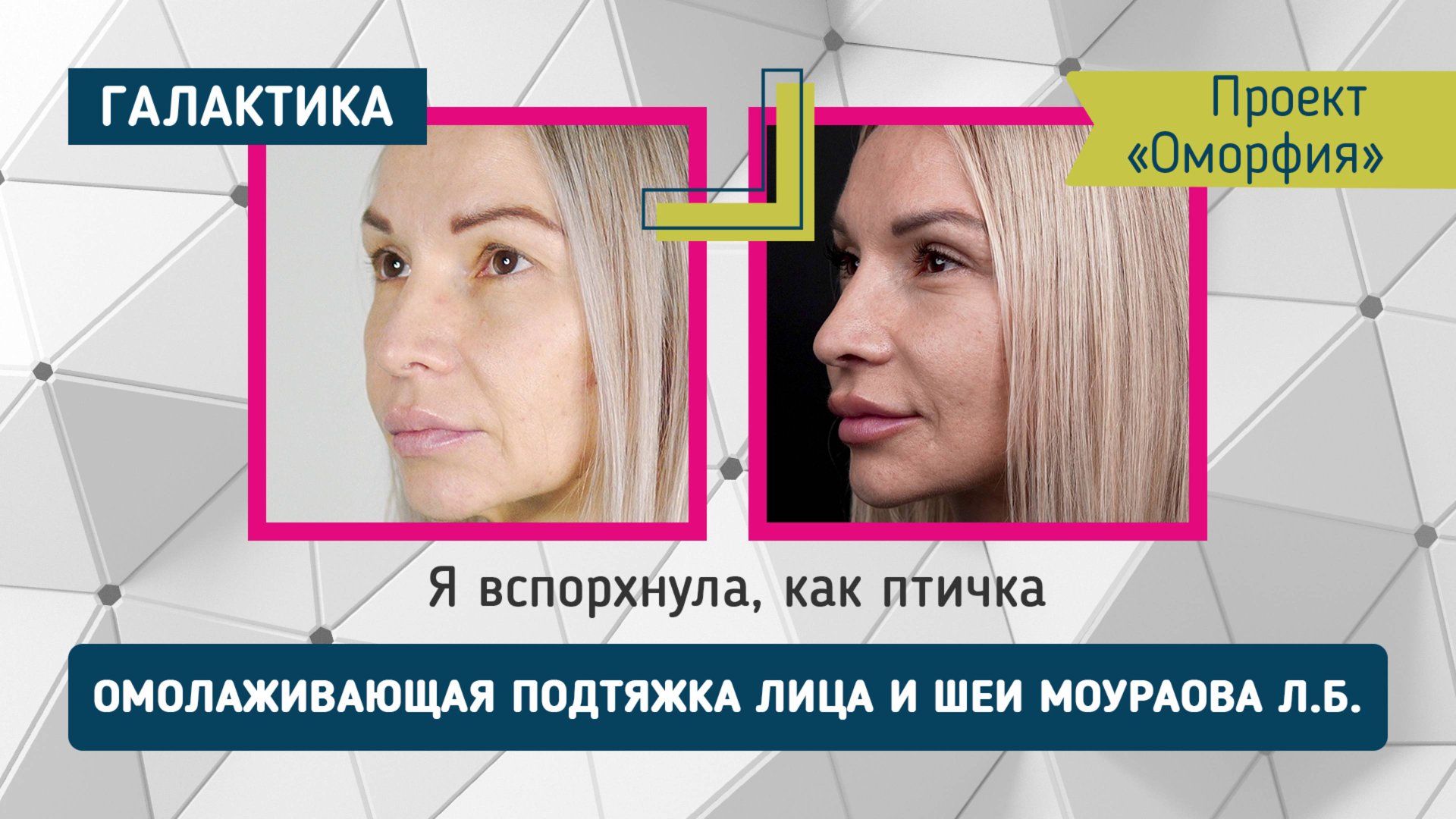 "Оморфия" - результат через три месяца | новая жизнь: лифтинг и блефаропластика у Ларисы Моураовой