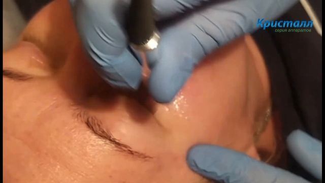 Лазерное омоложение. ППИЭ смотреть онлайн